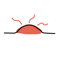 ニキビ